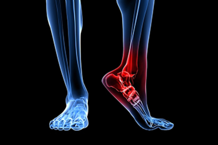 Causes and Treatment of Heel Bone Fractures